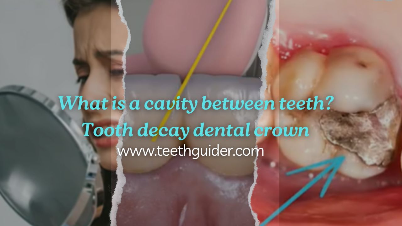 What is a cavity between teeth? Tooth decay dental crown