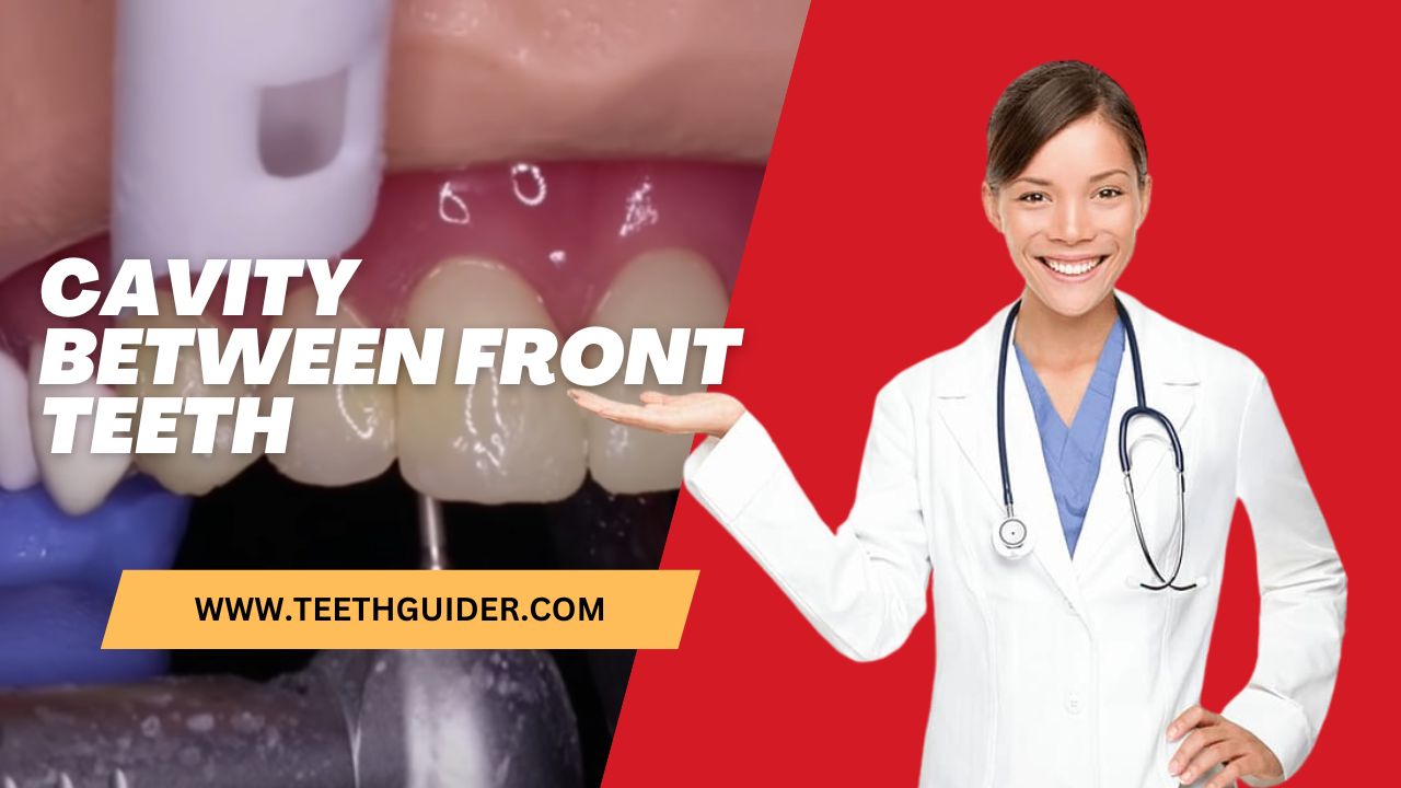 Cavity Between Front Teeth